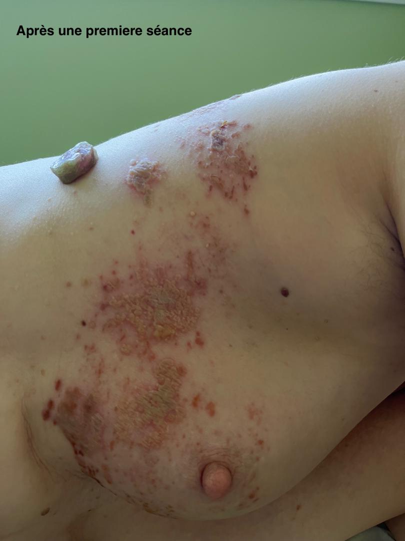 Zona coté droit après séance